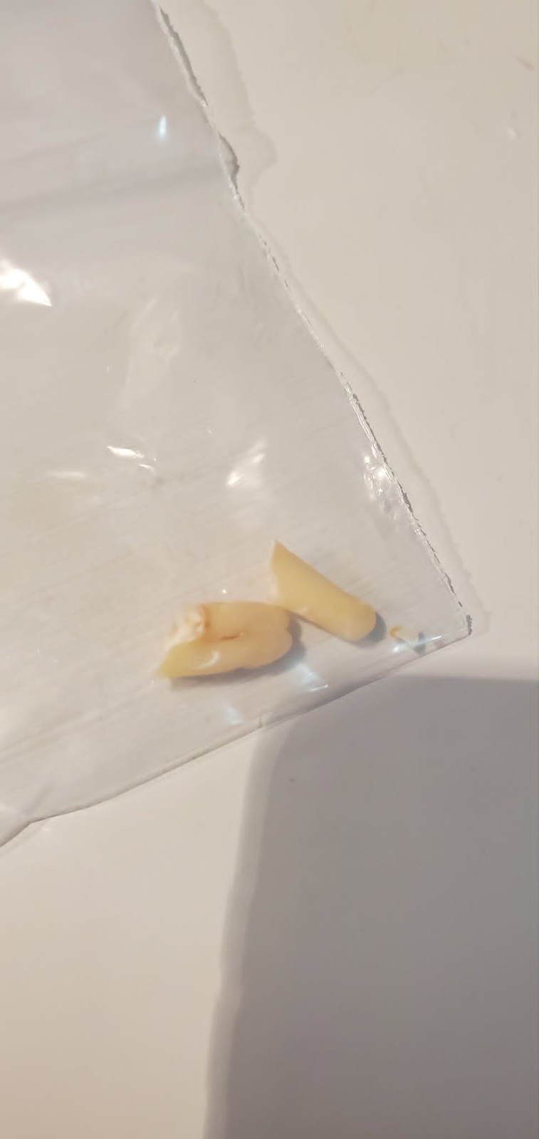 Genuine Human Molar Teeth Specimens - Set of 2 Extracted Dental Study Artifacts
