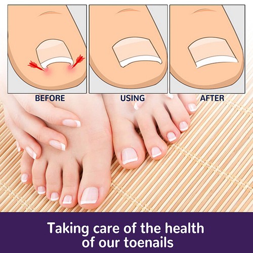 50Pcs Ingrown Toenail Corrector Sticker Nail Strip Corrector Stick-C9 - Picture 4 of 9