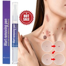 5ml Warts Removal Pen Filiform Warts Flat Warts Condyloma Acuminatum Wart Liquid
