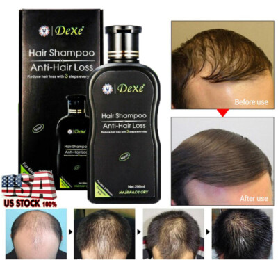 200ml Dexe Original Anti Hair Loss Shampoo Natural Herbal Hair Growth Treatment