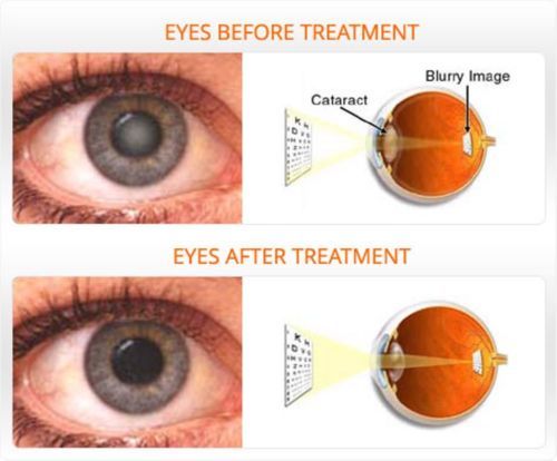3x Isotine Plus Eye Drop (10ml Each) For Cataract & Glaucoma 100% Ayurvedic
