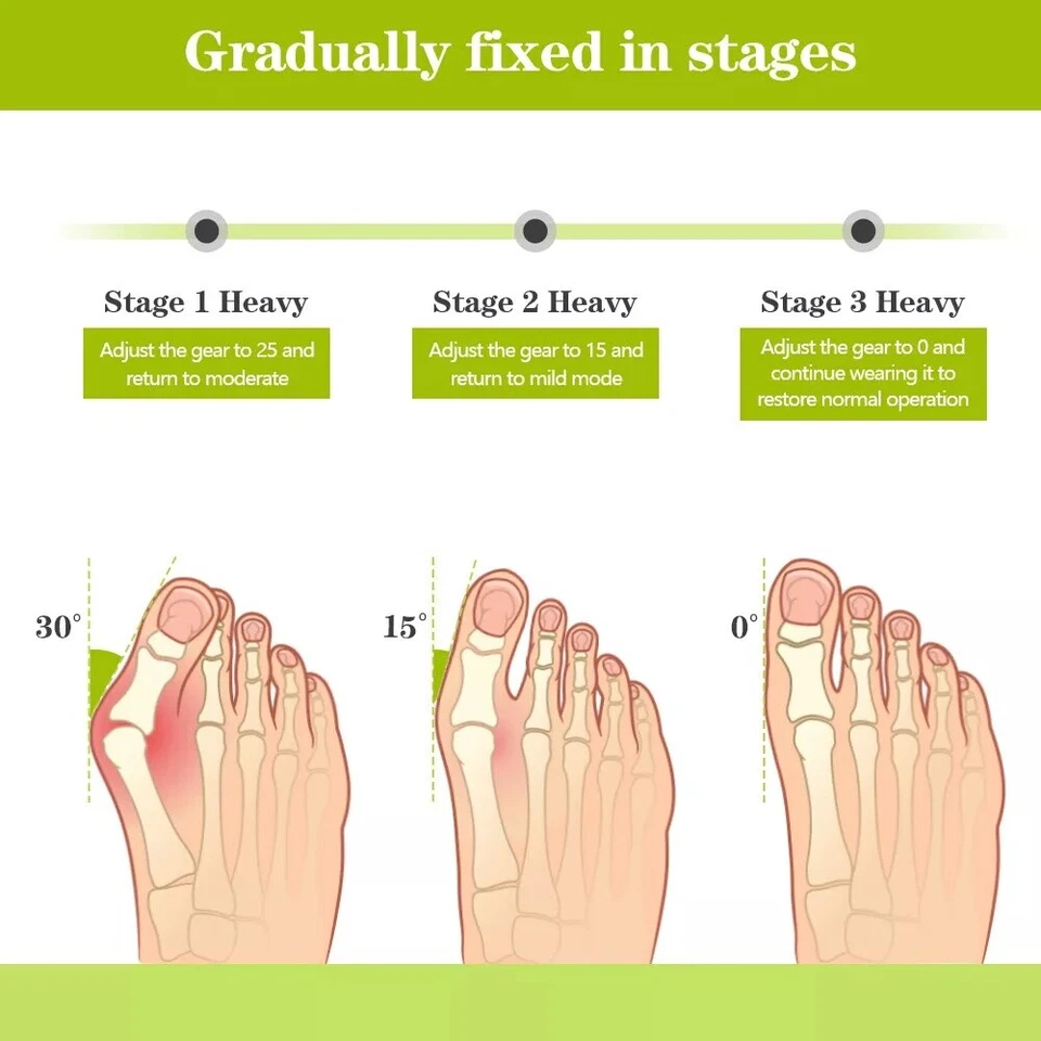 Big Toe Corrector Straightener Hallux Valgus Bunion Support Splint Pain Relief - Image 3 of 4