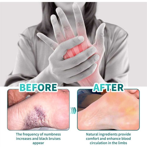 New Numbness Cream Neuropathy Nerve Pain Relief Cream Strength For Hand Feet Leg - Picture 5 of 11
