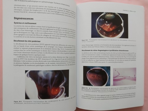 Pathologische Anatomie in der Augenheilkunde, Intraokulartumoren, Eye MD Ass - Bild 6 von 10