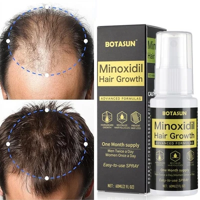 BOTASUN Minoxidil 5% Haarwachstum Serum Spray für Männer Haarwuchsmittel 1 Monats-Vorrat