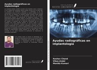 Ayudas RadiográFicas En ImplantologíA Monika Kumari