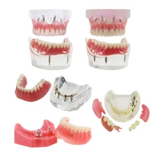 Dental 2/4 Implant Overdenture Restoration Typodont Model NISSIN Kilgore Style