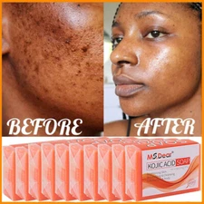 1-10X Kojic Acid Soap Face Body Wash Skin Clean Spot Corrector Acne Scar Remover