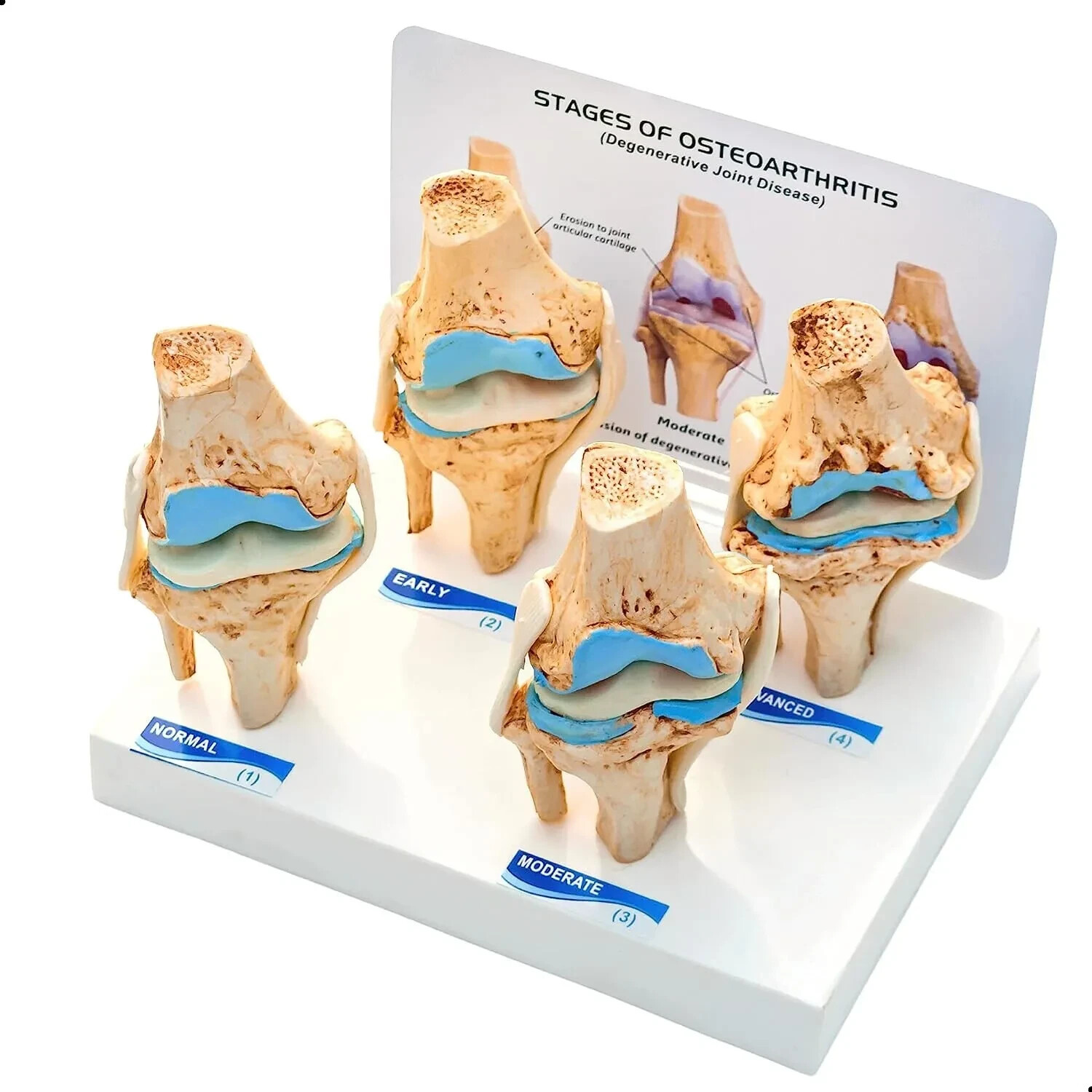 KNEE JOINT ARTHRITIS MODEL 4 Stage Osteoarthritis Anatomical Body Model ...