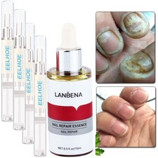 Toe Nail Fungus Treatmen Killer Anti Fungal Infection Treat Toe Finger Toenail