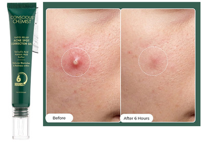 Conscious Chemist Relief Acne Spot Corrector Gel with 2% Salicylic Acid 15gm