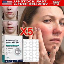 5BOX Skin Tag Wart Acne Remover Microneedle Patches 144pcs Blemish Spot Stickers