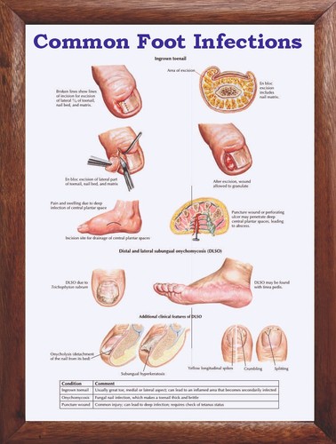 Common Foot Infections  Chart 12x18 inches - Picture 1 of 5