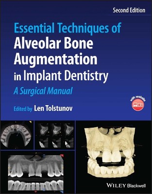 Essential Techniques of Alveolar Bone Augmentation in Implant Dentistry: A Surgi