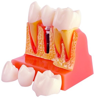 Dental Implant Model with Removable Crown Bridge - 4 Times Enlarged...