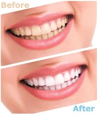 Advanced Teeth Whitening Strips (8 Strips) 4 Upper and 4 Lower~Hydrogen Peroxide