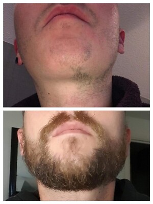 Best Product For Beard Growth (3 Month Kit)