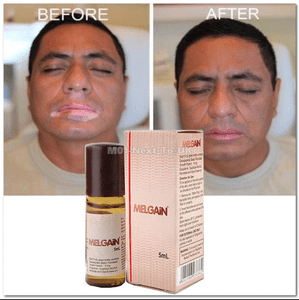 Melgain Lotion For Vitiligo White Spots Patches Re Pigmentation