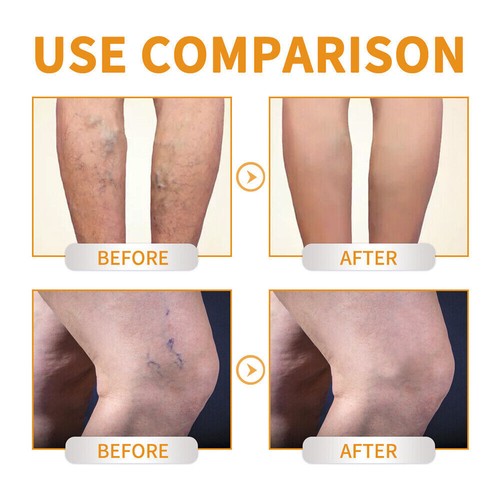 60g Vitamin K Cream Spider Varicose Veins Scars Rosacea Capillaries Dark Circles - Picture 8 of 12