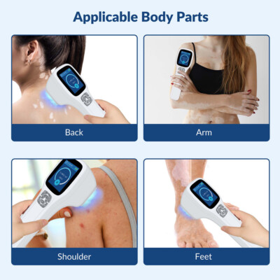 308nm Excimer Uvb Light Therapy Home Use Phototherapy Device for