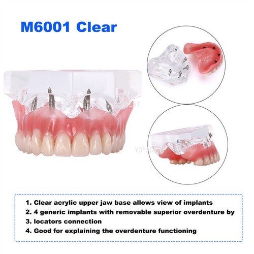 Modelo de dientes tipodonte dental ortoimplante patológico período práctica modelo de demostración - Imagen 31 de 49