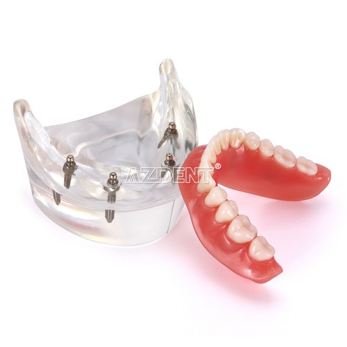 US Dental Implant Teeth Model Demo Overdenture Restoration With Implants U/L - Picture 10 of 27