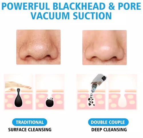Blackhead Remover Pore Vacuum,Facial Pore Cleaner-5 Suction Power,5 Probes,USB✅ - Picture 5 of 11