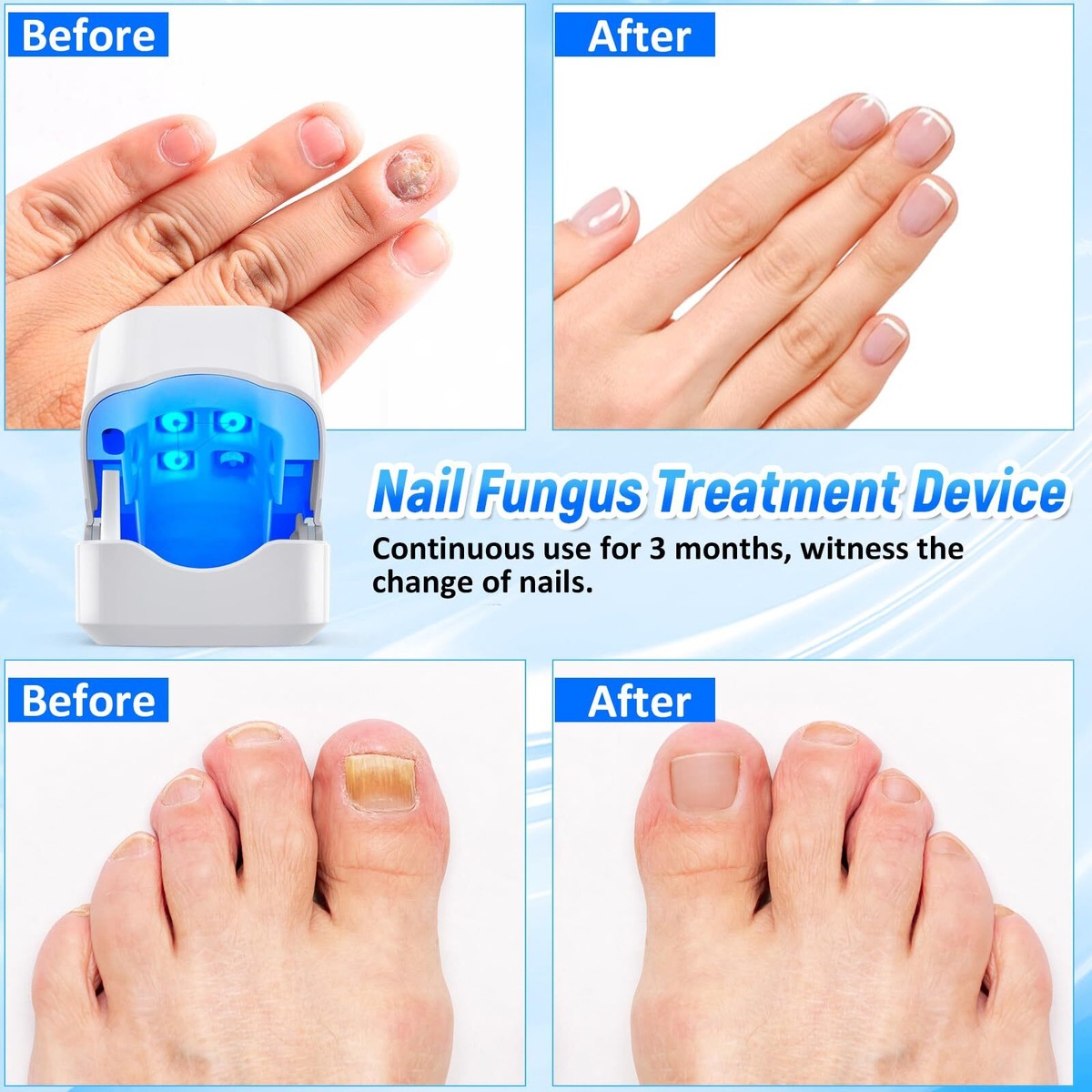 Appareil Laser Anti Mycose Ongles Ortho Vital - Neuf Sans Prise, Marque Pipihome