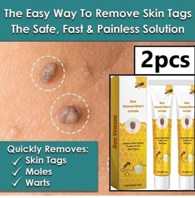 SKIN TAG REMOVER LIQUID CREAM SAFE NATURAL TREATMENT MOLES WARTS & TAGS 2pcs