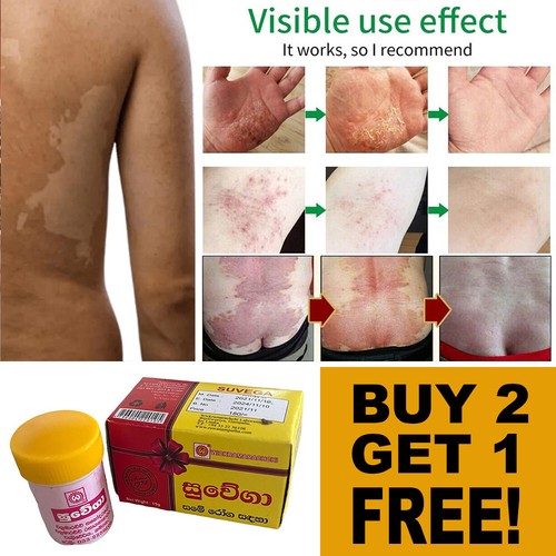 TINEA VERSICOLOR Antifungal Herbal Cream Treats Eczema Itch Skin Rash