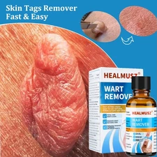 HEALMUSZ Wart Remover Liquid Plantar Wart Removers for Feet Body Fast Acting