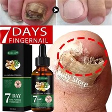 Fungal Nail Treatment Strong Fungus Remover Antifungal Liquid Serum Paronychia