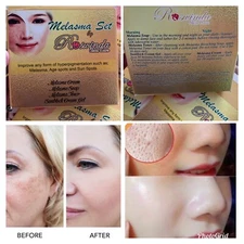 Melasma Set Remove Dark Spot Blemishes Acne Pimples Hyperpigmentation and more