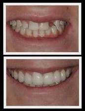 Dental resin TEMPORARY TOOTH REPAIR or REPLACE False Teeth Solid Glue KIT DIY