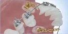 1bag10pcs Dental Orthodontic Traction Chain Gold Plated Round Buttons with Chain