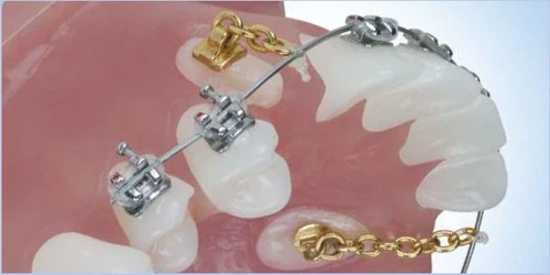 10pcs Dental Orthodontic Traction Chain Gold Plated Round Buttons with Chain