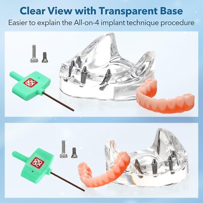 Dental All-on-4 Overdenture Implant Model Upper/Lower Jaw-Clear With 4 Screw US