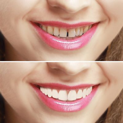 Imako Kosmetik Zähne, Snap On Smile, Veneers - Multipack x2 Stück