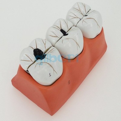 Human Dental Teeth Model Patient Education Model Caries Treatment Model *gi