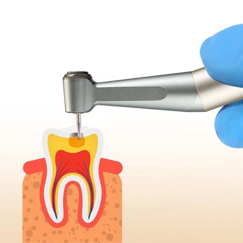 Frese dentali in acciaio al carburo di tungsteno contrangolo a bassa velocità - 第 70/92 張圖片