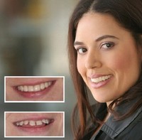 Imako Cosmetic Upper Teeth (bleached, Small) Imako Cosmetic Upper Teeth (bleached, Small)