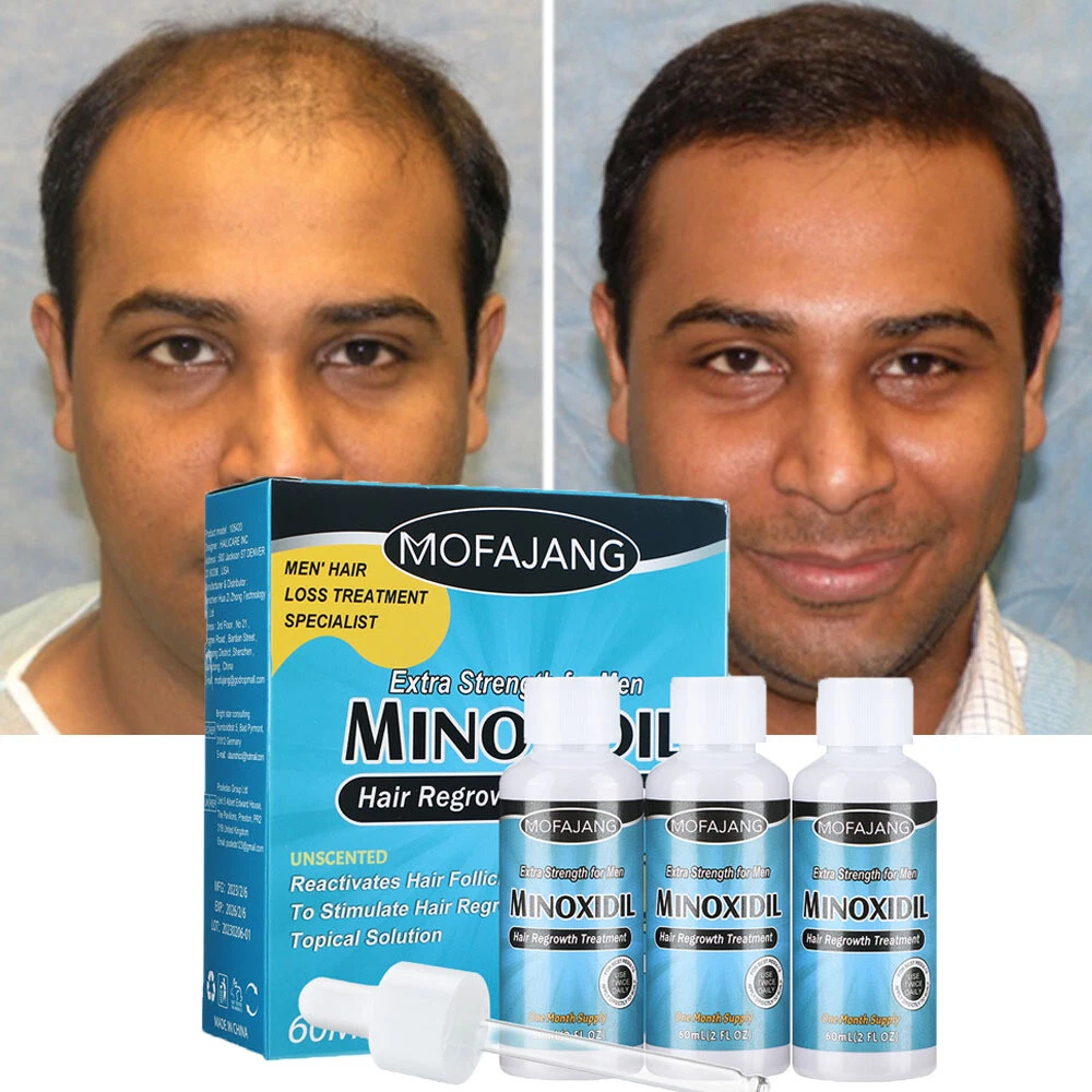 Hair loss treatment deals