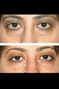 wow dark circle remover