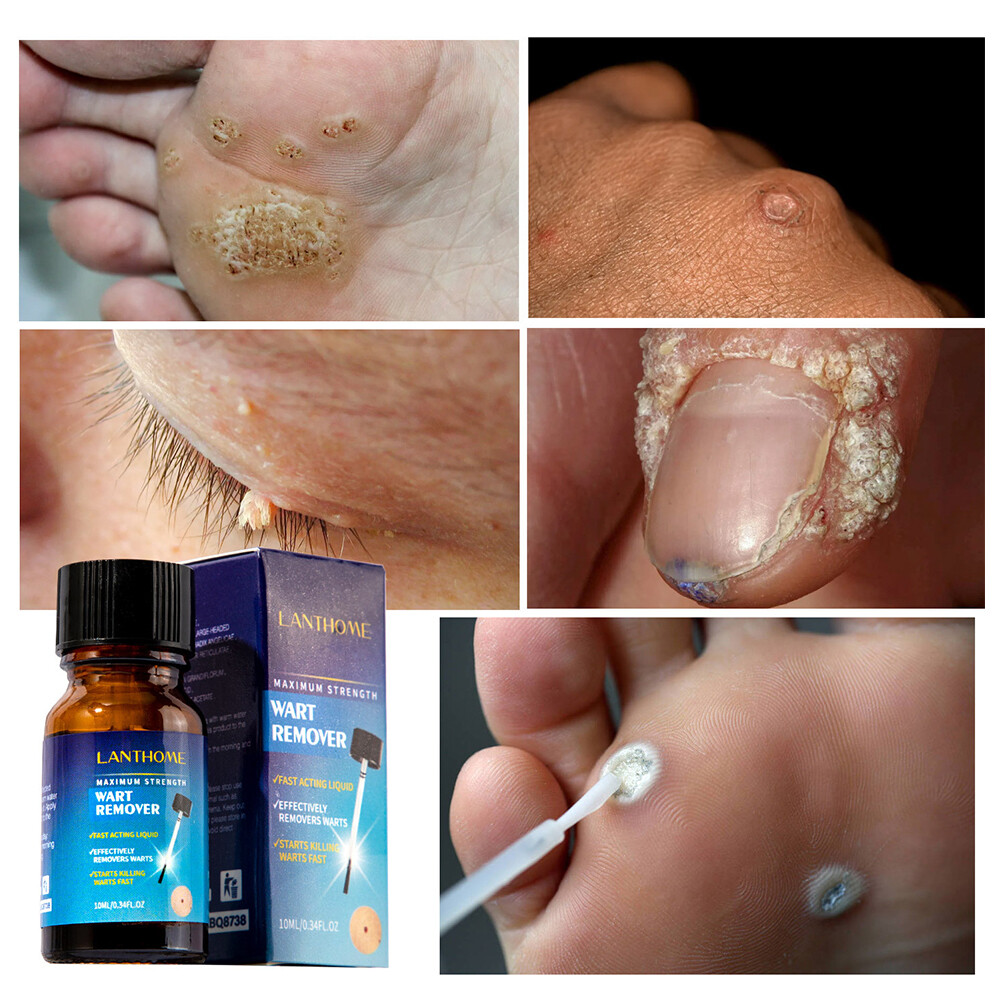 Top more than 153 nail polish remover for warts ceg.edu.vn