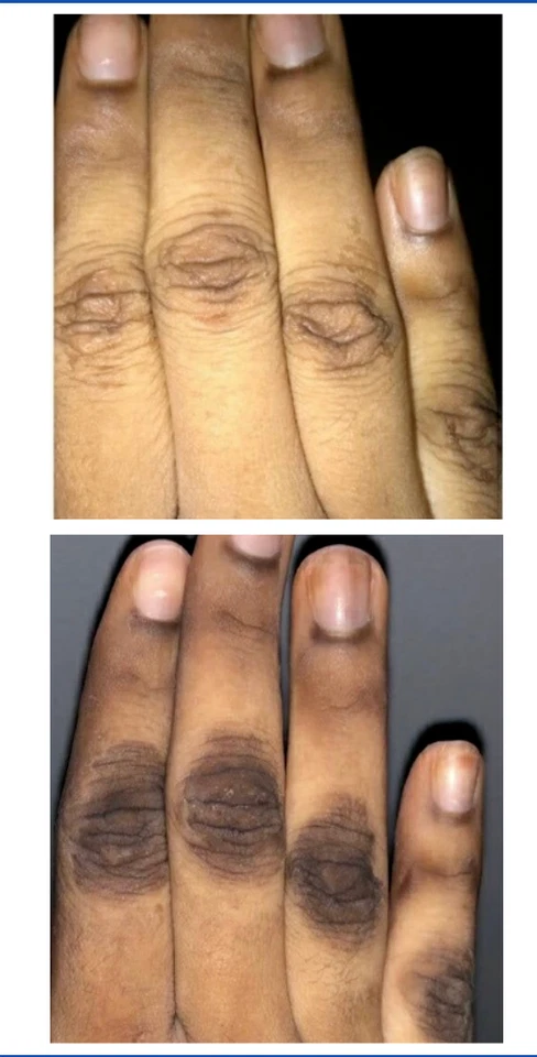 2Pk- Aceite blanqueador aclarador de ácido kójico blanqueador de nudillos oscuros AHA + crema Foto 2 de 4