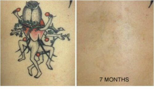 Permanente Tattooentfernung Creme MADE IN USA T - Bild 5 von 6