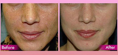 ÁCIDO GLICÓLICO 15% PEELING QUÍMICO 1/3 OZ ROLL-ON AHA ARRUGAS ACNES PUNTOS NEGROS - Imagen 3 de 5