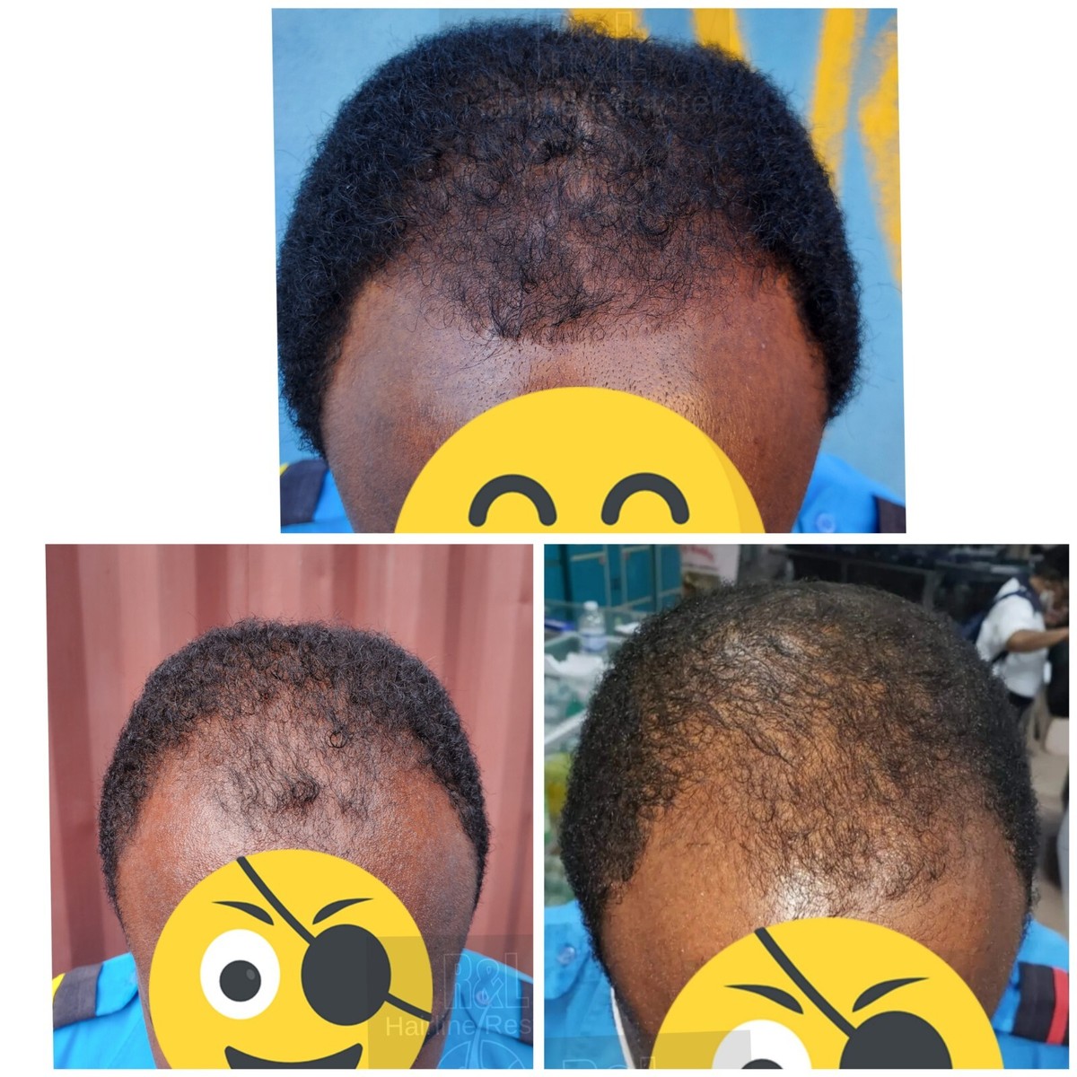 Female Pattern Baldness Receding Hairline