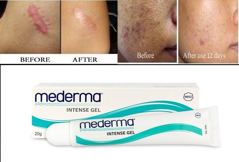 mederma for acne