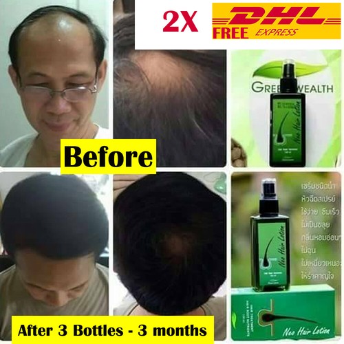 Neo Hair Lotion Promotes Hair Growth 120ml in Nepal at NPR 19073